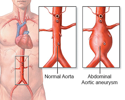 Abdominal Aortic Aneurysm