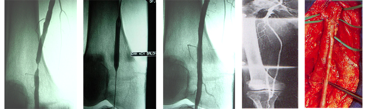 Arterial Leg Diseases